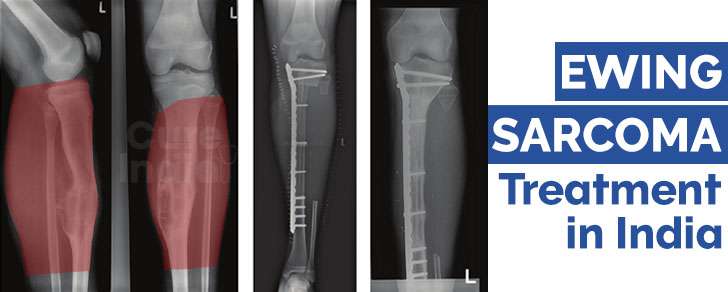 Ewing Sarcoma